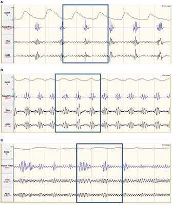 Post-Stroke Sleep-Disordered Breathing—Pathophysiology and Therapy Options